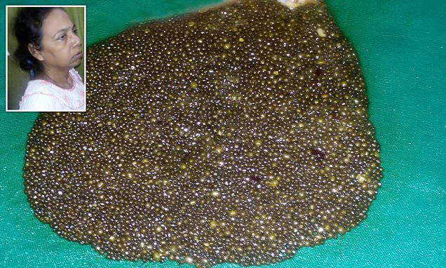 11,950 Gall Stones Removed