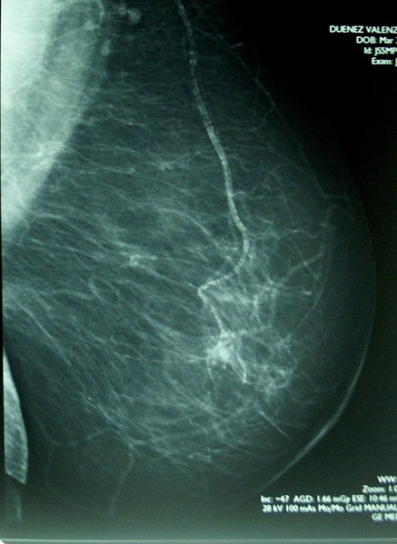 mamografija2